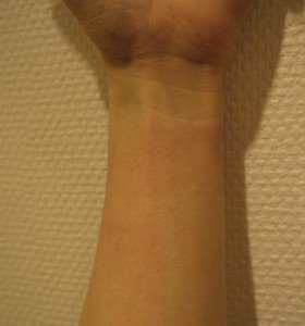 0330wrist3-280x300 - image