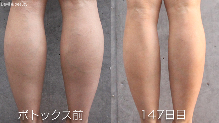calves-botox-before-day-147 - image