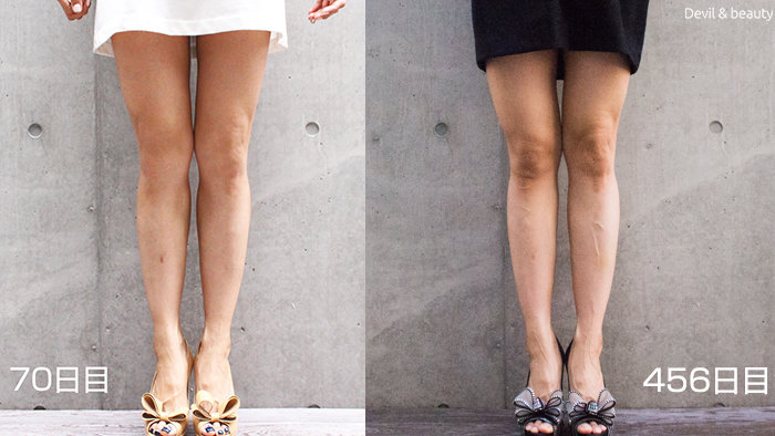 calves-botox-70days-456days - image