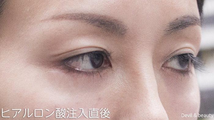 hyaluronic-acid-injection-under-the-eyes-immediately-after2 - image