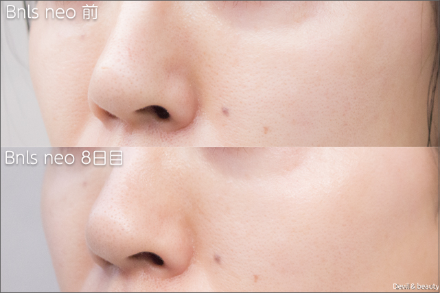before-after-bnls-neo-1st-nose-day8-left - image