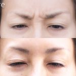 berofe-after-botox-between-the-eyebrows-150x150 - image