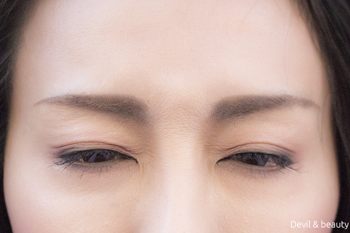 botox-between-the-eyebrows3 - image