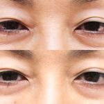before-after-botox-eyes-150x150 - image