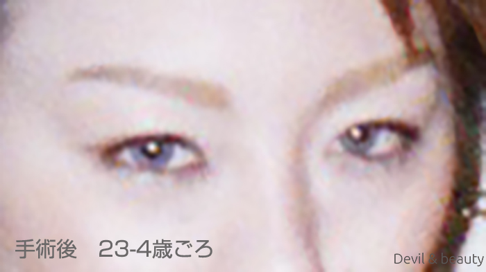 berofe-7th-surgery-eye2 - image