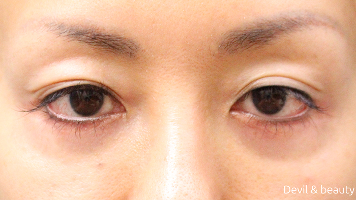 eyelift-surgery1 - image