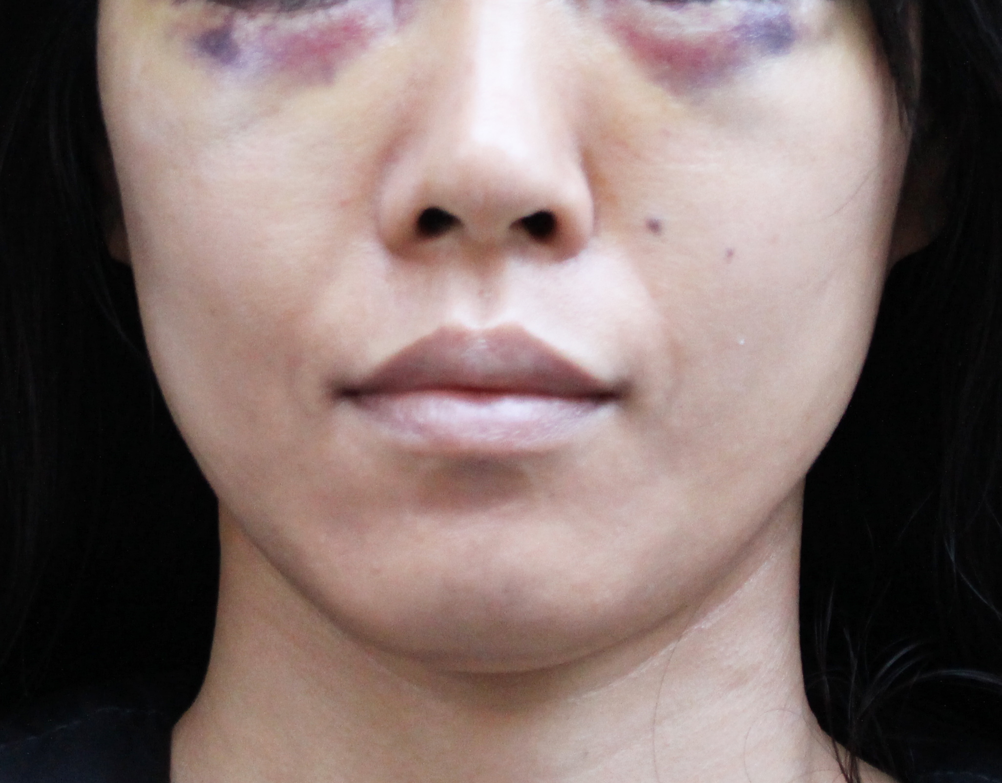 目のくまをハムラ法で治療したビフォーアフター3日目と裏ハムラ法との違い | 美容の悪魔