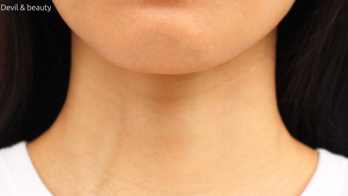 wrinkles-of-neck-e1475815830560 - image