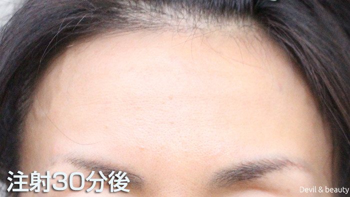 after-botox-injection-forehead - image