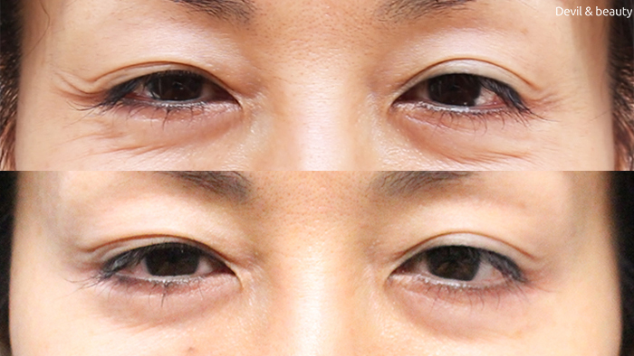 before-after-botox-eyes - image